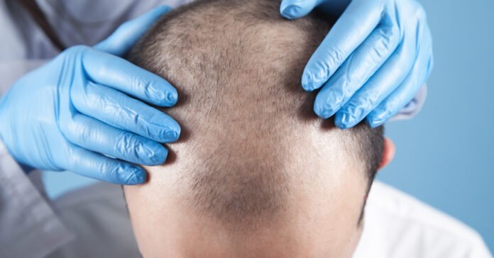 FUE hair transplant in Lucknow